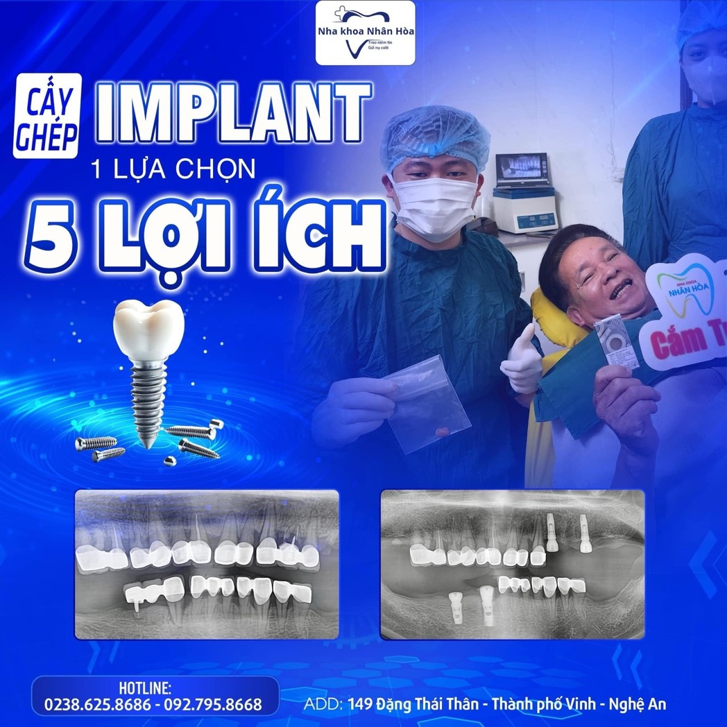 Cấy ghép Implant