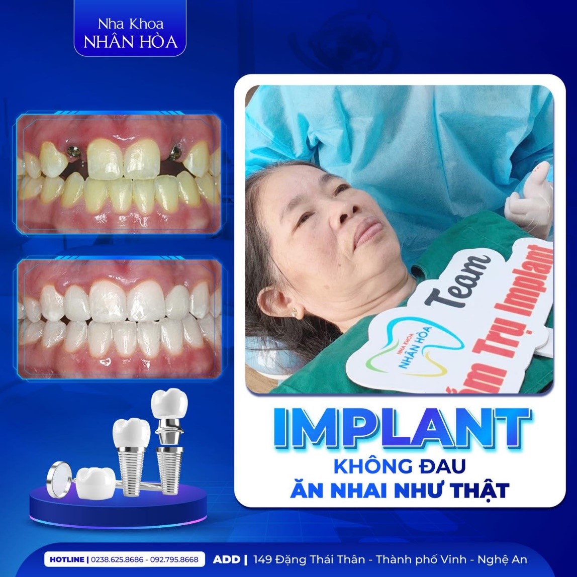 Cấy ghép Implant
